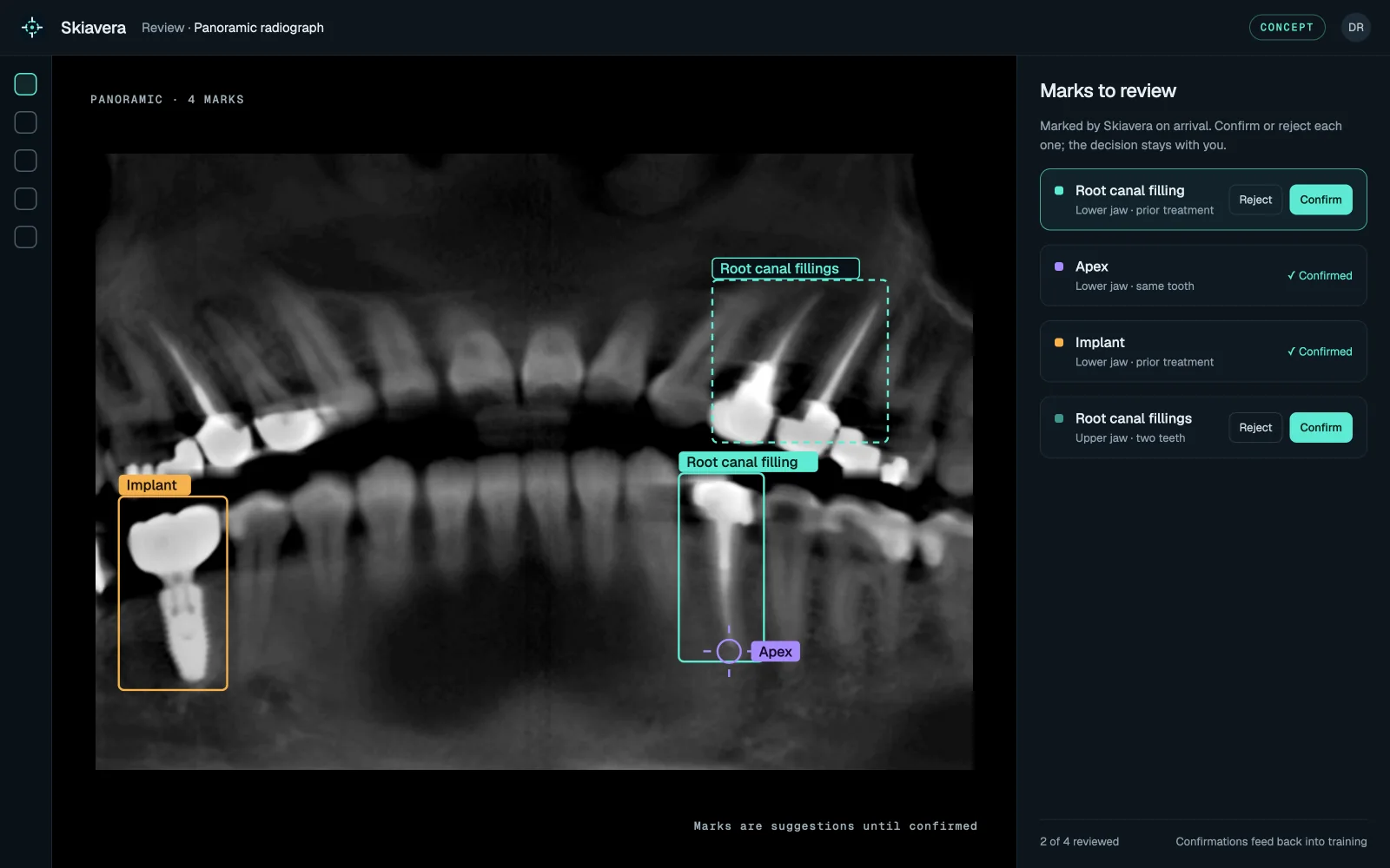 Concept of the Skiavera review screen: a panoramic radiograph with marked root canal fillings, an apex and an implant, and a panel to confirm or reject each mark